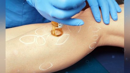 Spider Vein Removal – What you Need to Know