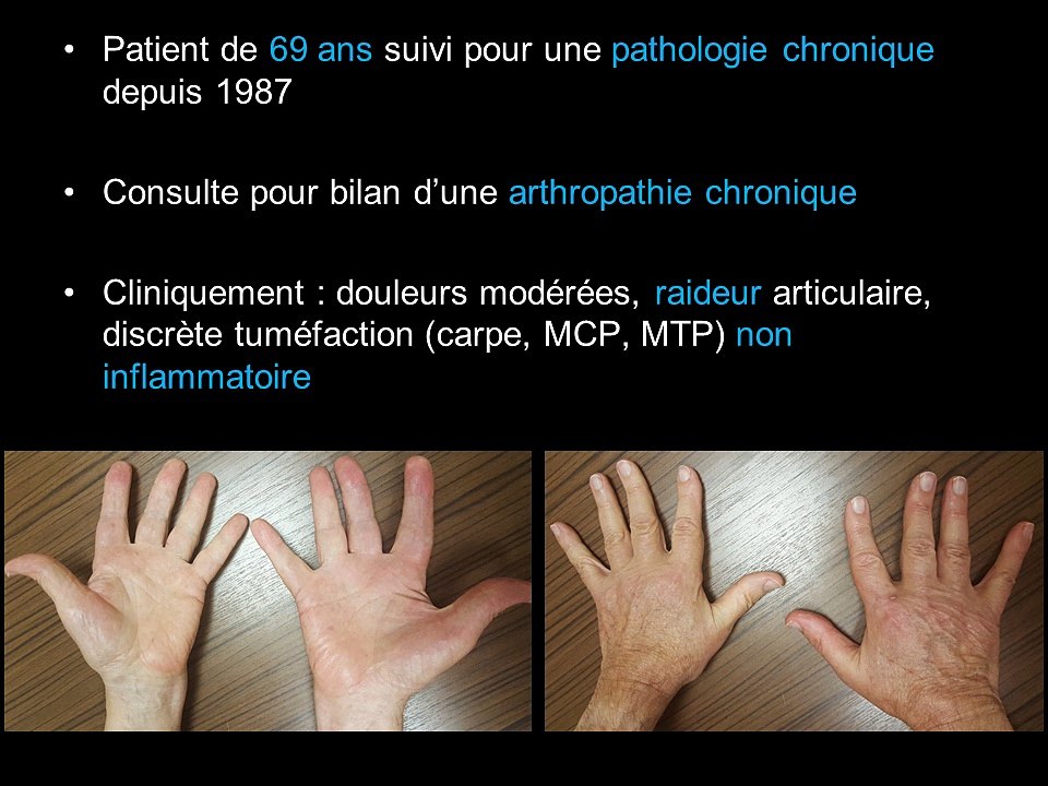 Une arthropathie chronique