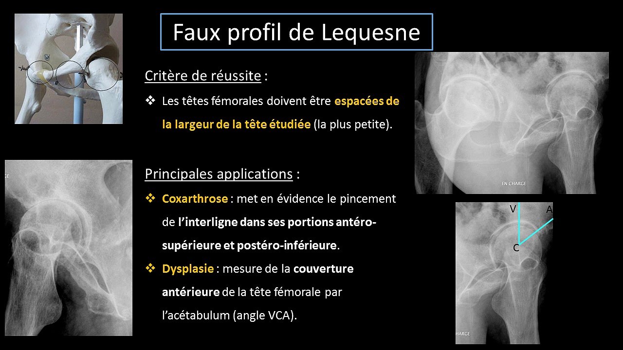 Qu'est-ce qu'un profils de hanche ?
