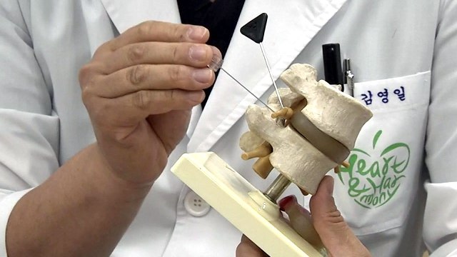 도침, '허리디스크 치료 효과' 과학적 입증 / YTN
