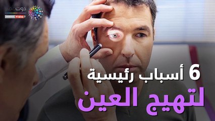 فيديو معلوماتى..تعرف على 6 أسباب رئيسية لتهيج العين