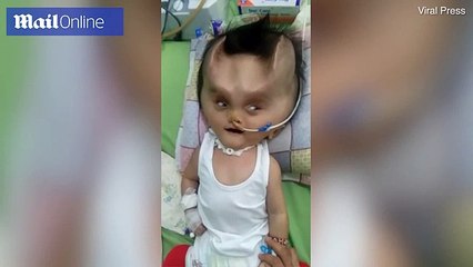 وصفه بالشيطان.. حالة نادرة جعلت لهذا الطفل قرنين مخيفين