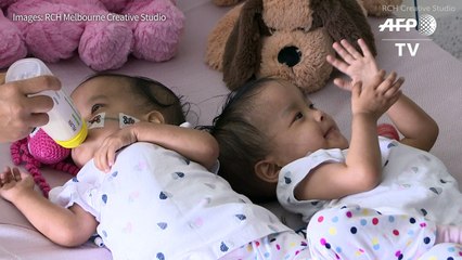 Ex-conjoined twins try out independence