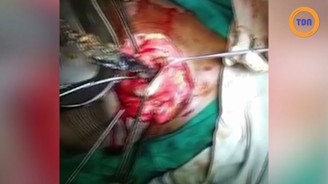 Atteinte d'acuphagie, elle mange des objets métalliques pointus !