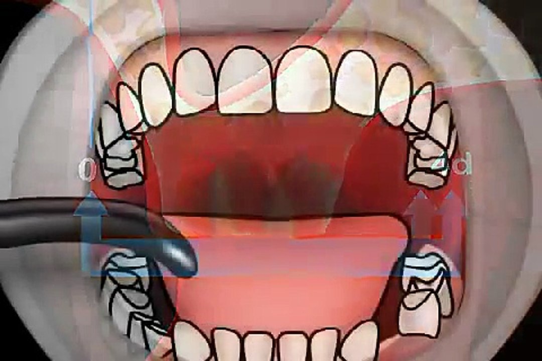 Schmerzen nach Zahn ziehen - die Alveolitis