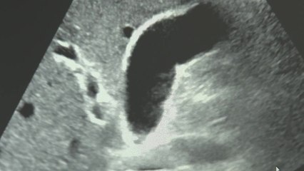 '내 몸에 돌' 담석증 환자 매년 늘어...50대 이상이 70% / YTN