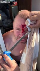 Le front arraché par un hameçon.. il coupe le morceau de peau !