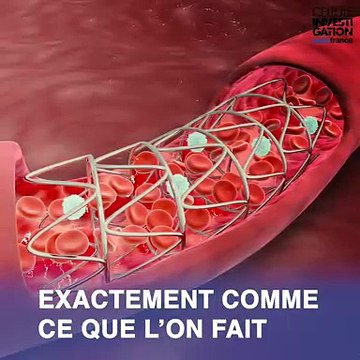 Des stents (ressorts métalliques) pour le cerveau provoquant des AVC