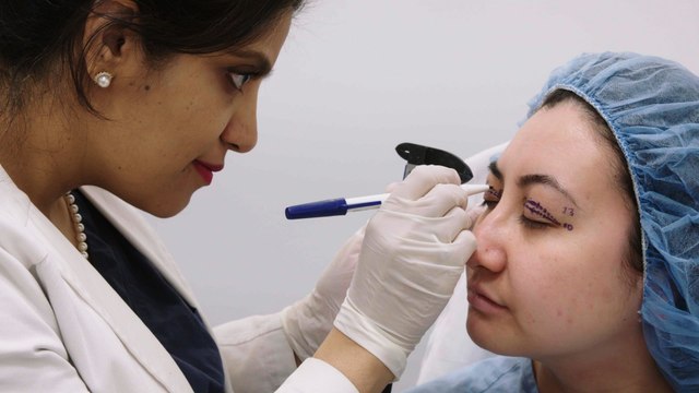 Here's What Upper Eyelid Blepharoplasty Looks Like | The Plastics