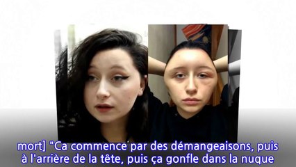 Cette femme de 19 ans défigurée à cause d'une coloration pour cheveux