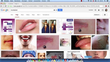 Wie behandelt man Mundecken oder Rhagaden?