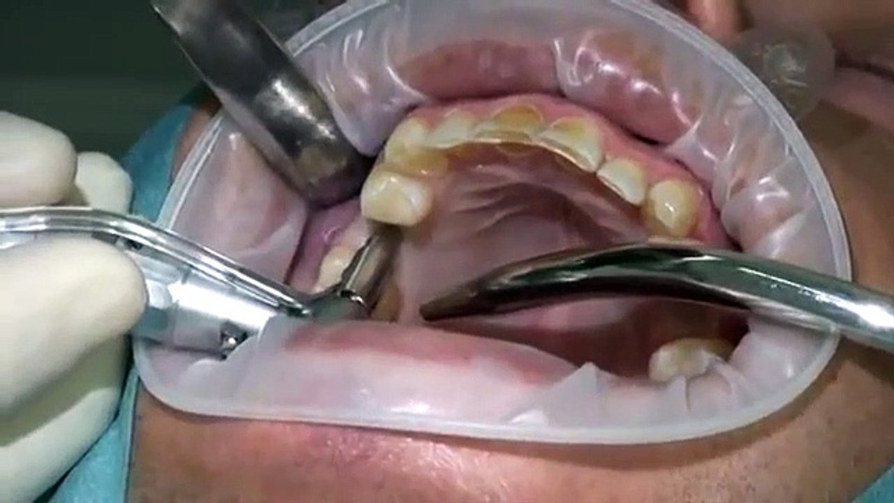 für Zahnärzte: Implantation ohne schneiden - stanzen