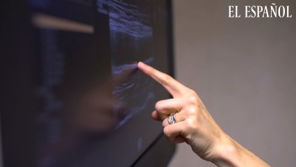 Ecografía 3D: un sistema pionero para identificar el riesgo cardiovascular