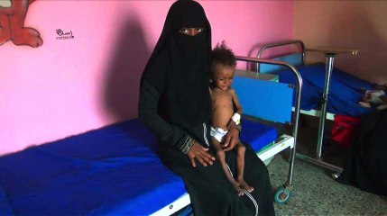 Yémen: un hôpital se débat pour sauver des enfants malnutris