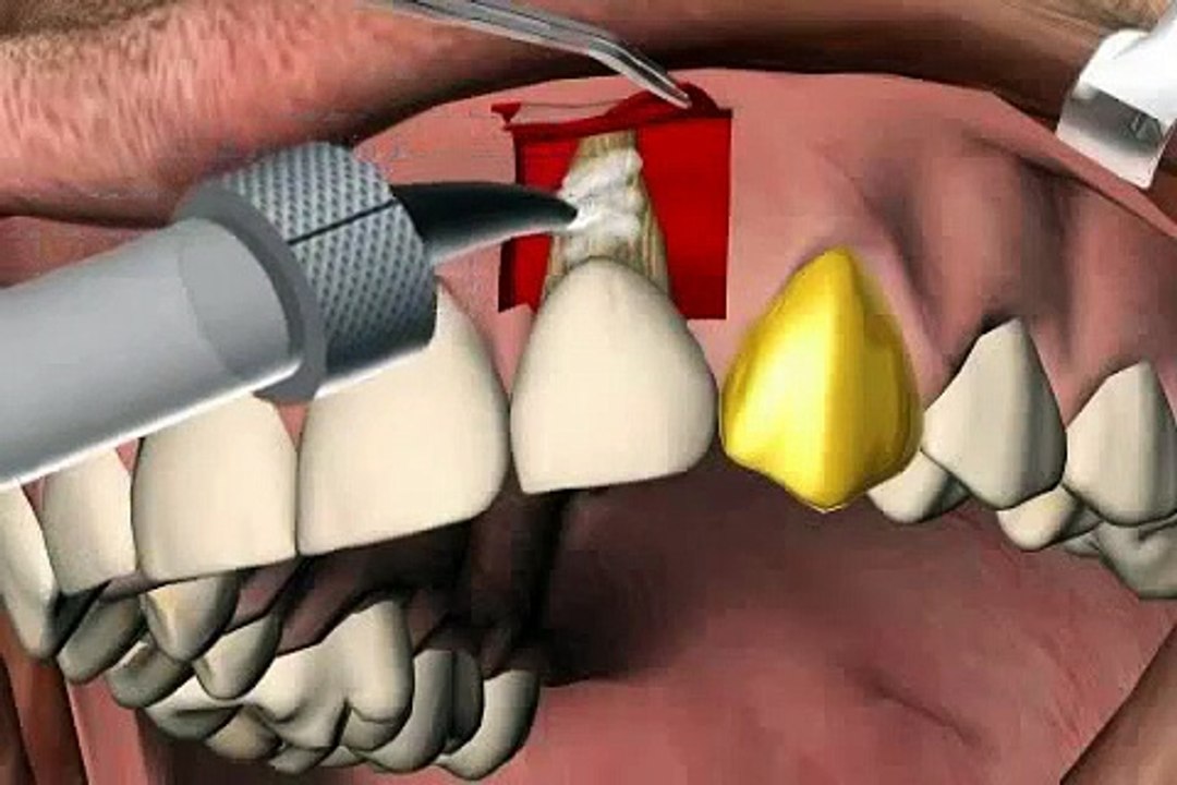 Behandlung von Zahnfleischrückgang - einer Rezessionsdeckung