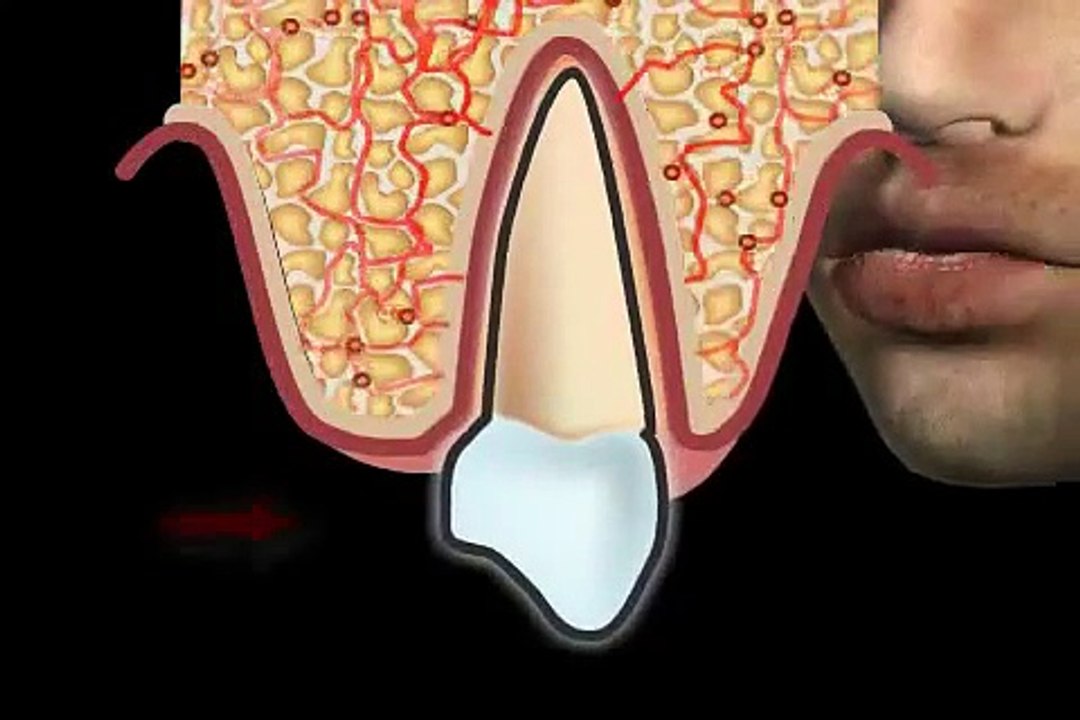 Wie kommt es zu Zahnfleischrückgang - Was ist eine Rezession