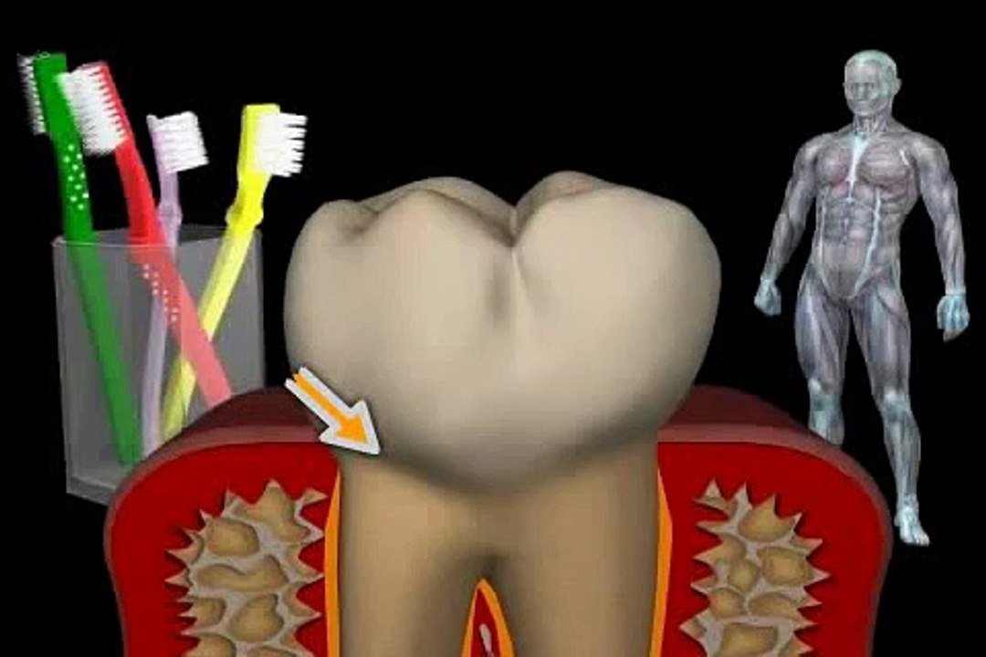 Was tun, wenn der Zahn einen Defekt am Zahnhals hat