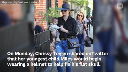 Chrissy Teigen's son Miles is going through helmet therapy. Here's what that means.