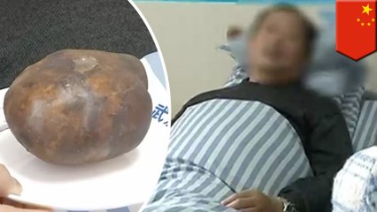Chinese man has massive bladder stone pulled out of him