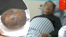 Chinese man has massive bladder stone pulled out of him