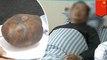 Batu ginjal sebesar telur burung unta dikeluarkan dari pria Cina - TomoNews