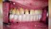 A well-informed dental implant patient is the best kind -- Greg's Story