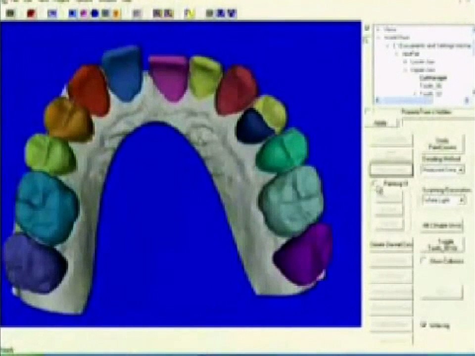 Was sind Aligner - unsichtbare Zahnspange
