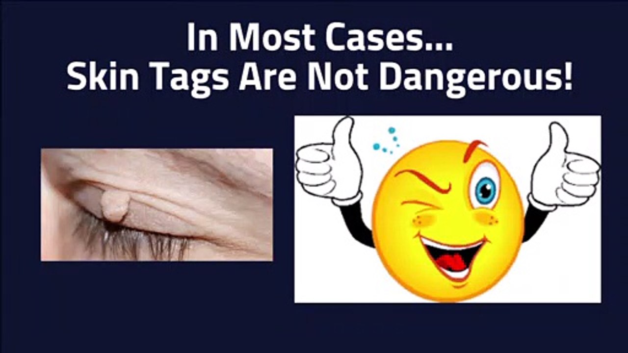 Skin Tags During Pregnancy