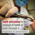 Why Tooth Extraction Isn’t as Bad as You Think
