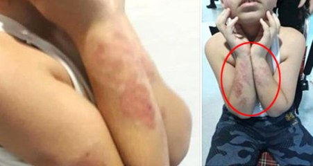 Rehabilitasyon Merkezine Giden Engelli Çocuğun Vücudundaki Darp İzleri Kan Dondurdu