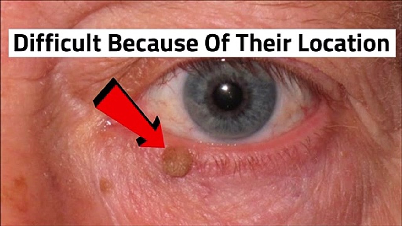 Skin Tags On Eyelids