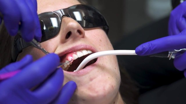 Laser Gum Contouring: Correcting Gummy Smiles in St. Augustine