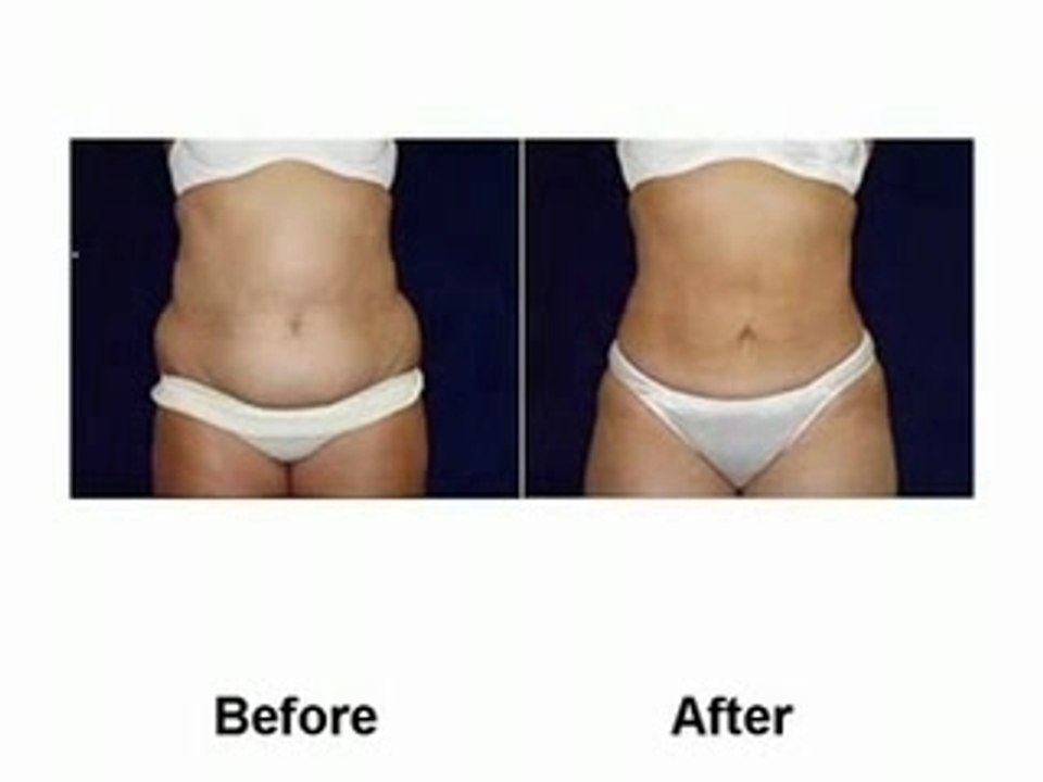 Liposuction Miracle