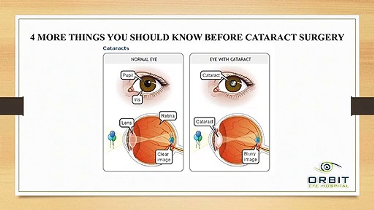 4 MORE THINGS YOU SHOULD KNOW BEFORE CATARACT SURGERY