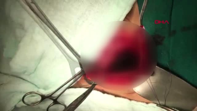 Şanlıurfa Otizmli Mehmet'in Midesinden Plastik Çay Kaşığı, Eldiven ve Kablo Çıktı-2