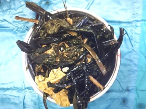 Şanlıurfa Otizmli Mehmet'in Midesinden Plastik Çay Kaşığı, Eldiven ve Kablo Çıktı-1