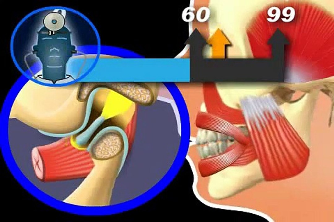 Knacken im Kiefergelenk - ist eine Therapie notwendig?