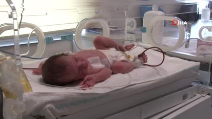 Doğduktan 16 Saat Sonra Yapılan "Yemek Borusu" ile Hayata Tutundu