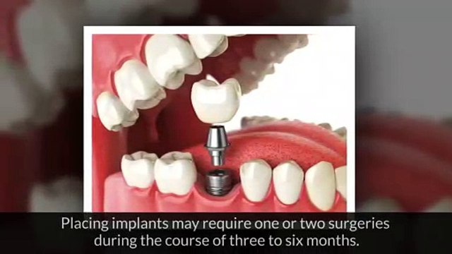 Should You Get Dental Implants, Find The Best Dentist in Arlington Heights