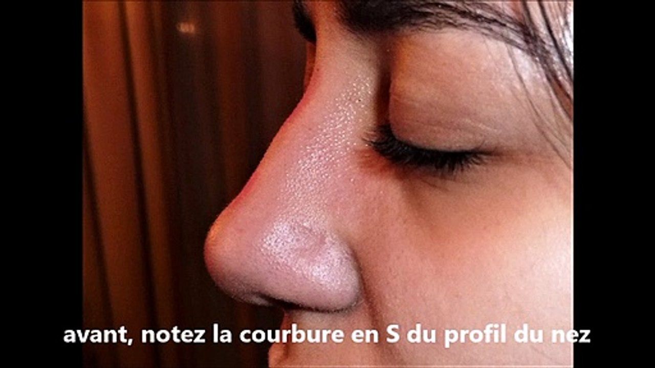 rhinoplastie correctrice médicale,avant après
