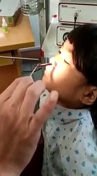 Un médecin retire une une étrange bestiole vivante du nez d'une fillette !