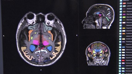 치매 예측 기술, 한국 연구 능력 빛냈다! / YTN