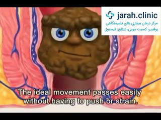 کلینیک نوین > شقاق مقعدی چیست؟ شیوه درمان شقاق با لیزر