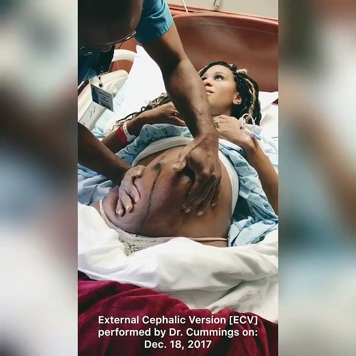 La scène impressionnante d'un médecin qui remet bébé 'dans le bon sens' en vue de l'accouchement