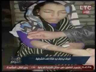 بالصور.. أشعة (البرق) تصيب فتاة بالشرقية وتتسبب بحرق يدها