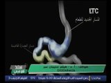 استاذ في الطب | مع غاده حشمت و أ.د هيثم سليمان عمر حول احدث طرق علاج السمنه -30-10-2016