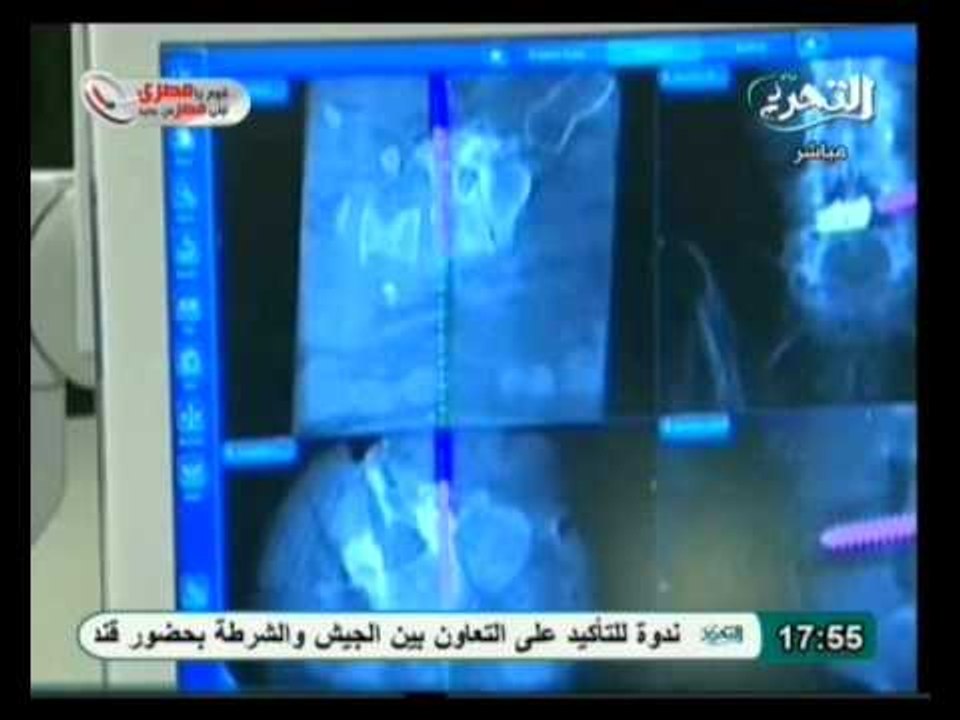 فيها حاجة حلوة: مشاكل العمود الفقري وعلاجها