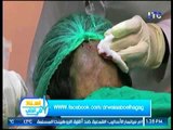 برنامج أستاذ في الطب | مع د. ولاء أبوالحجاج حول علاج تسساقط الشعر 23-7-2017
