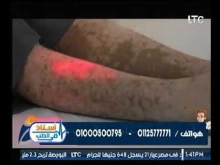 برنامج استاذ فى الطب | مع د. ولاء ابو الحجاج  " كيف تتخلص من البهاق ؟ " 19-9-2017