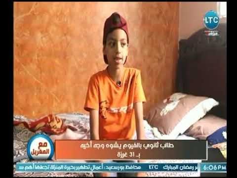 بعد تشويه وجه بـ21 غرزة .. طفل بالابتدائي يكشف تفاصيل الاعتداء عليه من قبل شقيق صديقه